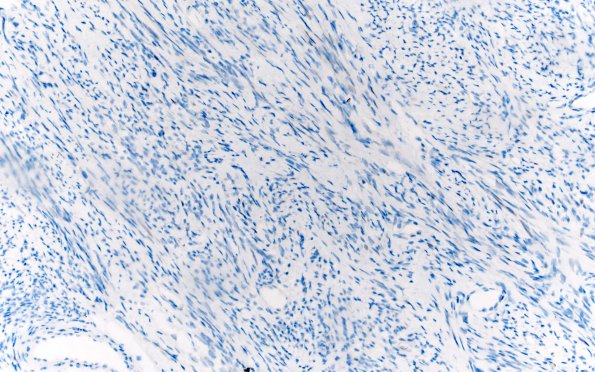 4D Solitary Fibrous Tumor (Case 4) PR 20X