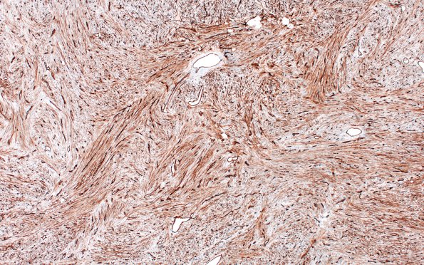 4E Solitary Fibrous Tumor (Case 4) CD34 4X