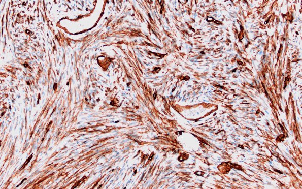 4E2 Solitary Fibrous Tumor (Case 4) CD34 20X