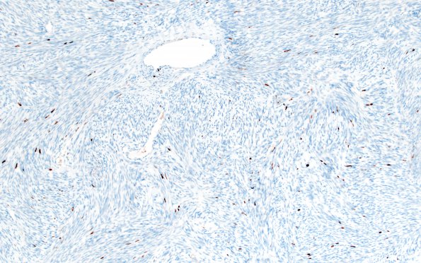 4F Solitary Fibrous Tumor (Case 4) Ki67 10X 2