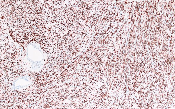 4G1 Solitary Fibrous Tumor (Case 4) STAT6 10X