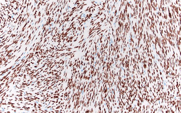 4G2 Solitary Fibrous Tumor (Case 4) STAT6 20X