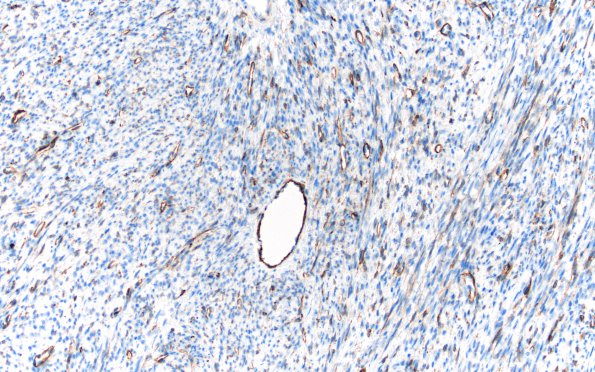 4H Solitary Fibrous Tumor (Case 4) SSt2A 20X