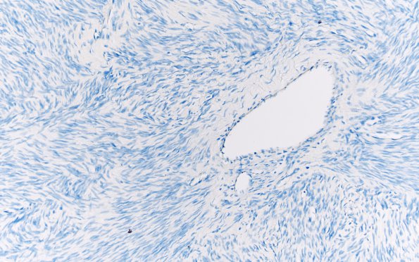 4I Solitary Fibrous Tumor (Case 4) S100 20X