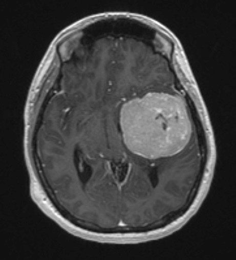 7A2 SFT (Case 7) T1W - Copy