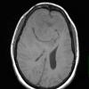 8A1 Hemangiopericytoma (Case 8) T1 1 - Copy