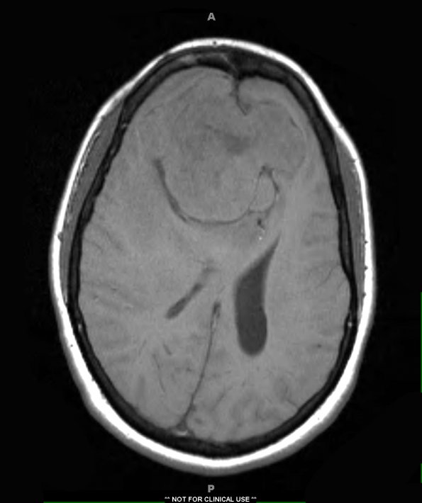 8A1 Hemangiopericytoma (Case 8) T1 1 - Copy