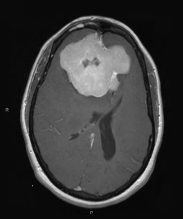 8A2 Hemangiopericytoma (Case 8) T1 W 1 - Copy