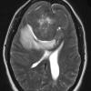 8A3 Hemangiopericytoma (Case 8) T2 W 2 - Copy