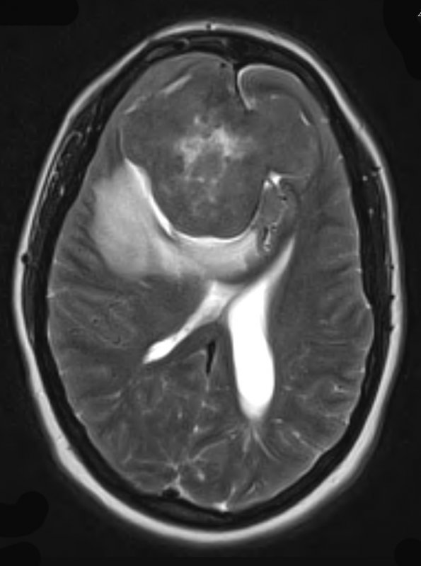 8A3 Hemangiopericytoma (Case 8) T2 W 2 - Copy