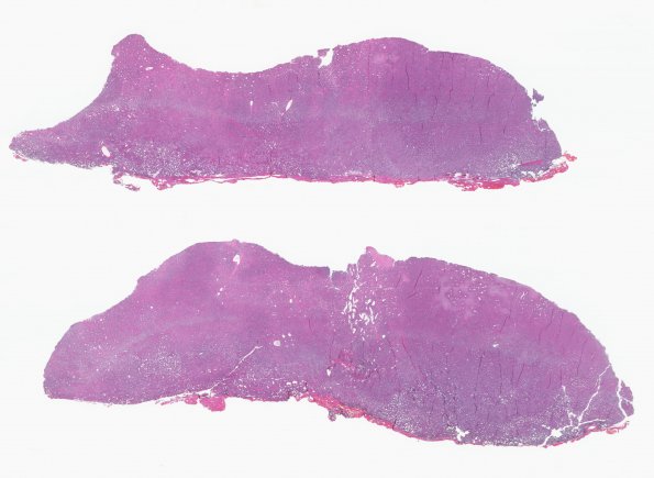 8B1 Hemangiopericytoma (Case 8) 1 H&E WM