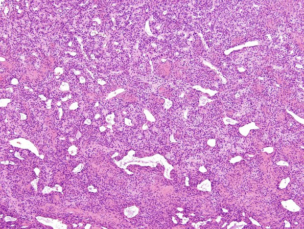 8B3 Hemangiopericytoma (Case 8) H&E 18