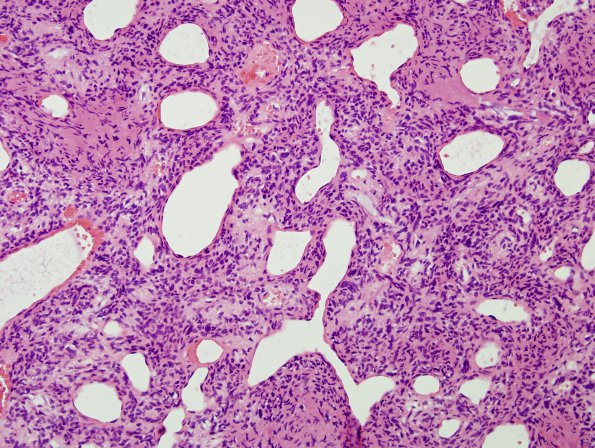 8B4 Hemangiopericytoma (Case 8) H&E 4