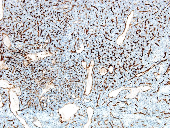 8C1 Hemangiopericytoma (Case 8) CD34 4