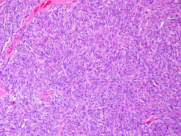 9A1 Hemangiopericytoma (HAP, Original Cervicomedullary site, Case 9) H&E 1.jpg