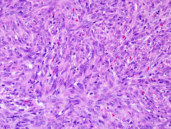 9A3 Hemangiopericytoma (HAP, Original Cervicomedullary site, Case 9) H&E 7.jpg