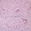 9C1 Hemangiopericytoma (HAP, Original Cervicomedullary site, Case 9) Retic 2.jpg