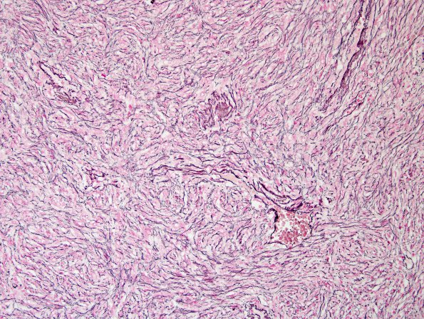 9C1 Hemangiopericytoma (HAP, Original Cervicomedullary site, Case 9) Retic 2.jpg