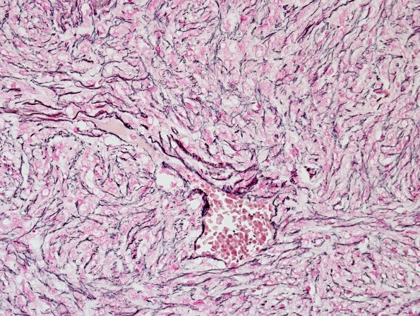 9C2 Hemangiopericytoma (HAP, Original Cervicomedullary site, Case 9) Retic 1.jpg