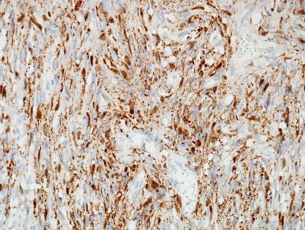 9E Hemangiopericytoma (HAP, Original Cervicomedullary site, Case 9) Factor 13a 1.jpg