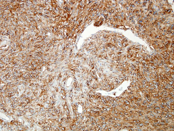 9F Hemangiopericytoma (HAP, Original Cervicomedullary site, Case 9) CD99 2.jpg