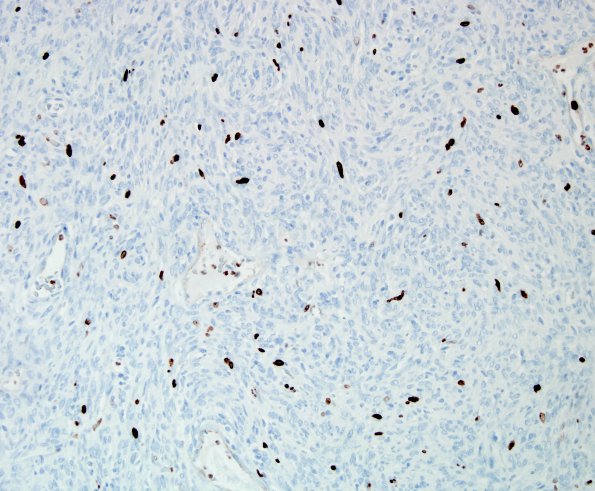 9H Hemangiopericytoma (HAP, Original Cervicomedullary site, Case 9) Ki67 2.jpg