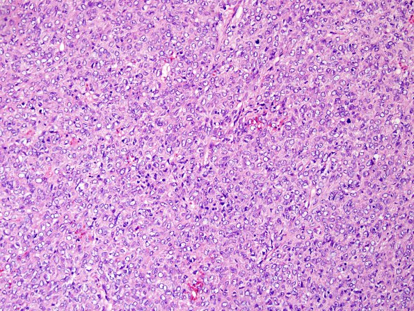 9J1 Hemangiopericytoma (HAP, Metastasis, Case 9) H&E 3.jpg