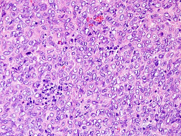 9J2 Hemangiopericytoma (HAP, Metastasis, Case 9) H&E 2.jpg