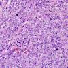 9J3 Hemangiopericytoma (HAP, Metastasis, Case 9) H&E 4.jpg