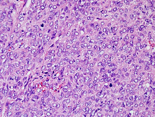 9J3 Hemangiopericytoma (HAP, Metastasis, Case 9) H&E 4.jpg