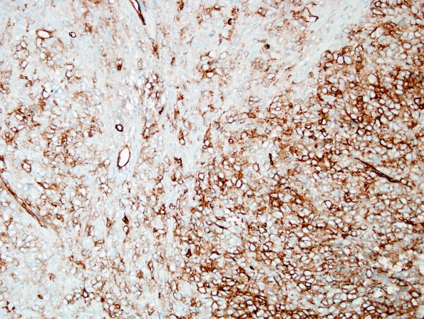 9L1 Hemangiopericytoma (HAP, Metastasis, Case 9) CD34 4.jpg