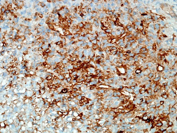 9L2 Hemangiopericytoma (HAP, Metastasis, Case 9) CD34 1.jpg