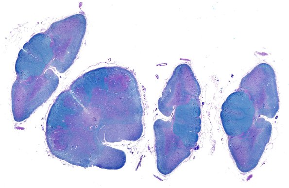 10B1 ALS (Case 10) LFB-PAS