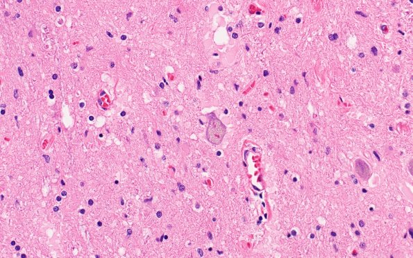 11A1 ALS (Case 11) N11 H&E 40X