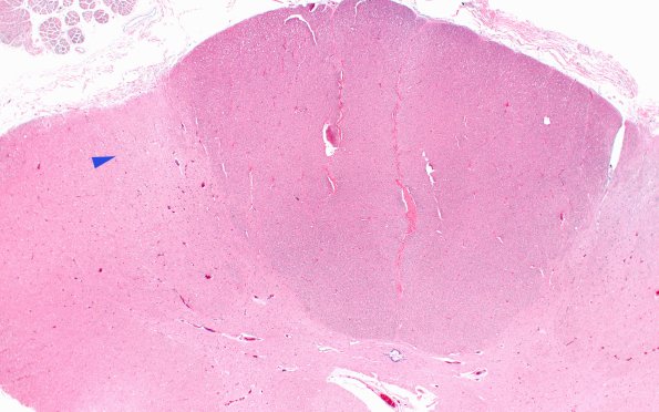 11B1 ALS (Case 11) N11 H&E 40X corticospinal tract 2X copy