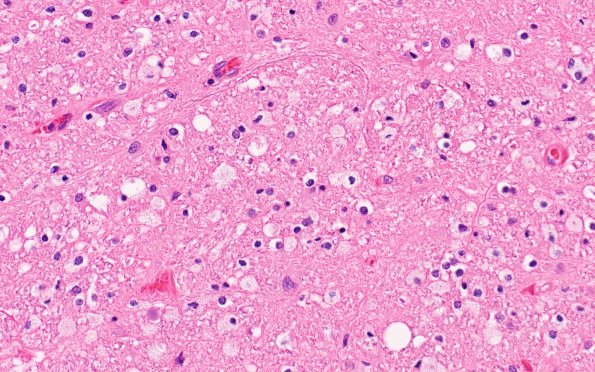 11B2 ALS (Case 11) N11 H&E 40X corticospinal tract 40X