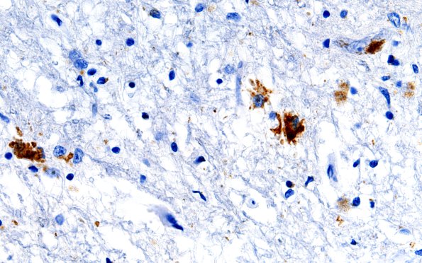 12B2 ALS (Case 12) LS N12 60X