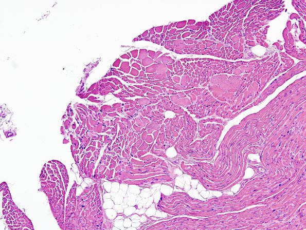 13A2 ALS TDP43 (Case 13A) H&E muscle