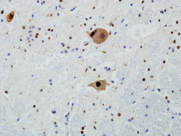 13A4 ALS (Case 13A) TDP-43 Hypoglossal 1