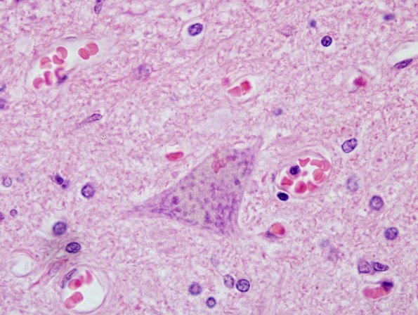 13H4 ALS (Case 13H) Bunina Body H&E 1