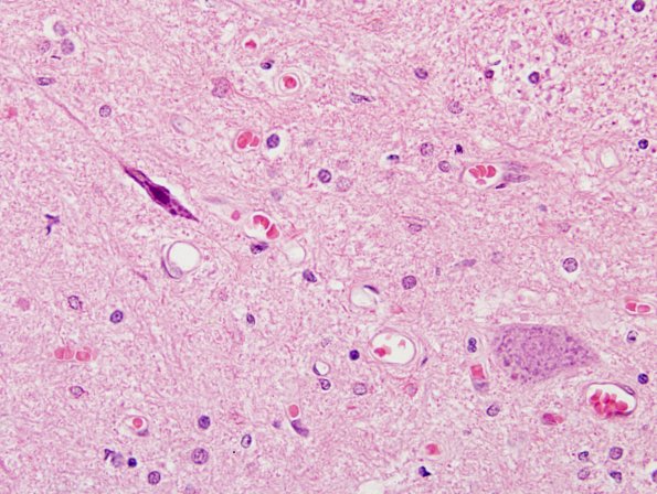 13H7 Atrophy, ALS motoneuron (Case 13H) H&E 60X a.jpg