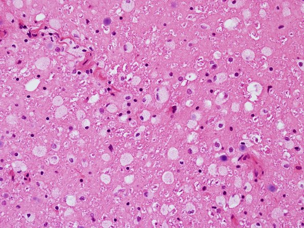 13N3 ALS (Case 13N Corticospinal tract H&E 2.jpg