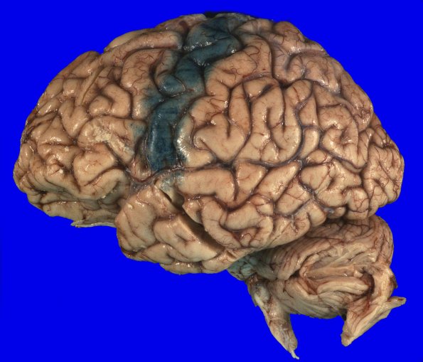 14A2 (Case 14) Gross _3