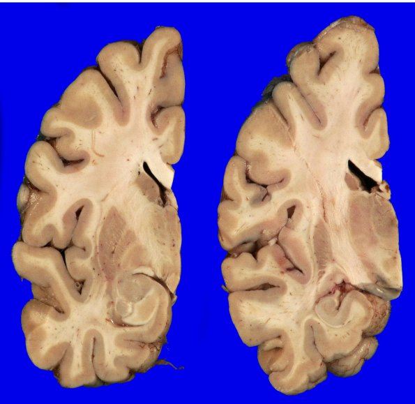 14A3 (Case 14) Gross _4