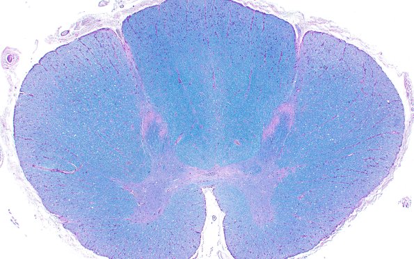 14D (Case 14) LFB-PAS N11 2X