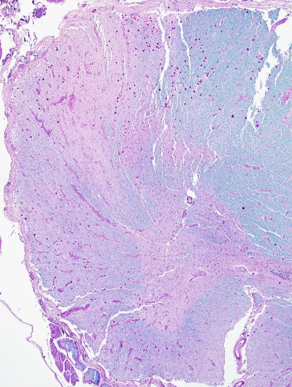 15F2 FTLD-ALS (Case 15) LFB-PAS N10 1A