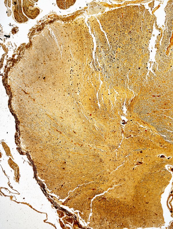 15G2 FTLD-ALS (Case 15) Biels N10 2A