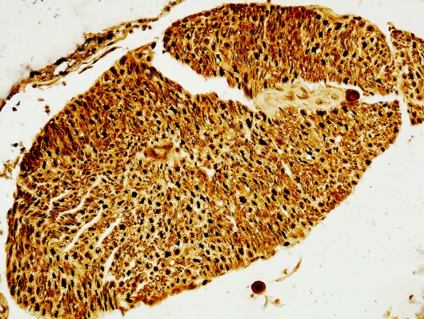 15H1 FTLD-ALS (Case 15) Biels N10 3B (DR) 40X