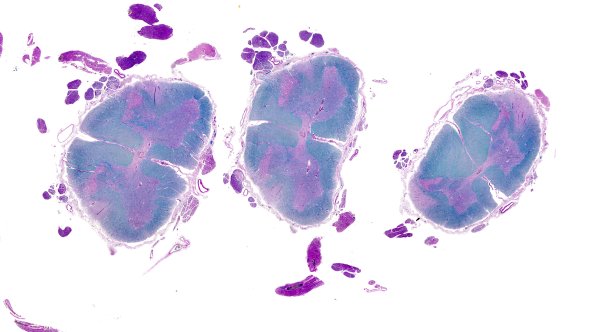 16C ALS (Case 16) N12 Lumbosacral LFB-PAS WM