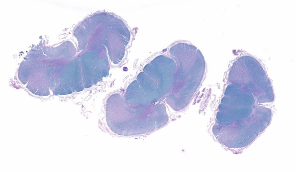 17C ALS (Case 17) N10 LFB-PAS WM